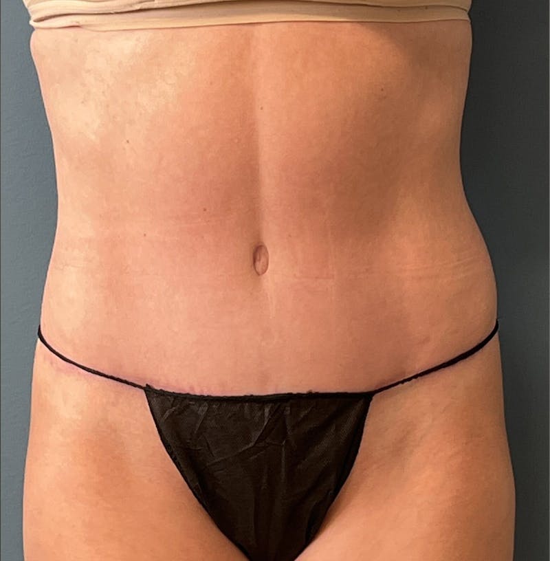 Tummy Tuck Before & After Gallery - Patient 336228 - Image 2