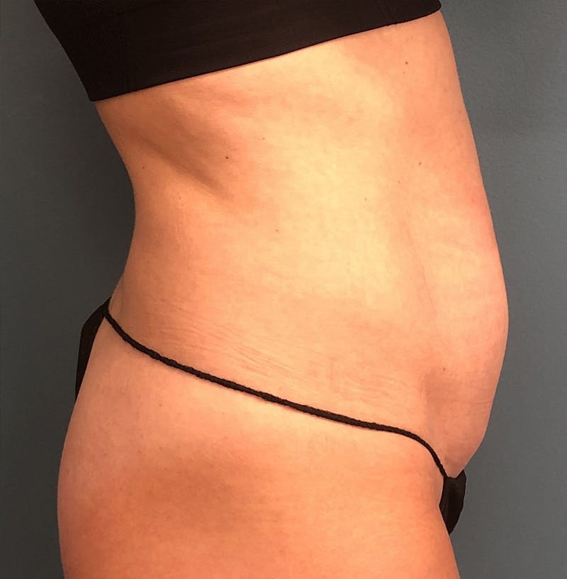 Tummy Tuck Before & After Gallery - Patient 336228 - Image 3