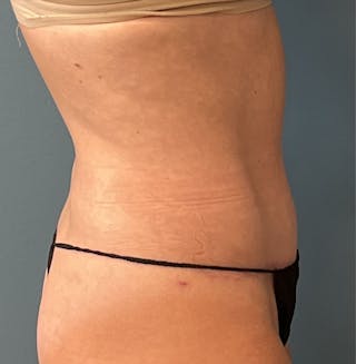 Tummy Tuck Before & After Gallery - Patient 336228 - Image 4