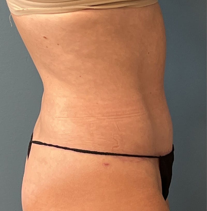 Tummy Tuck Before & After Gallery - Patient 336228 - Image 4