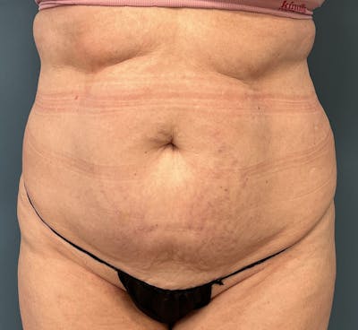 Tummy Tuck Before & After Gallery - Patient 292225 - Image 1
