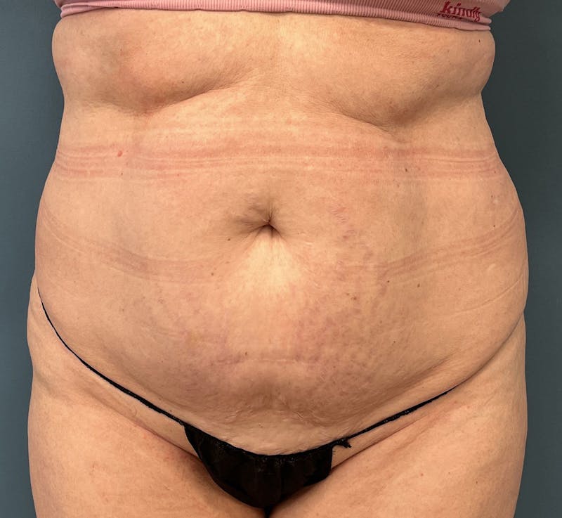 Tummy Tuck Before & After Gallery - Patient 292225 - Image 1