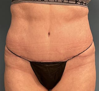 Tummy Tuck Before & After Gallery - Patient 292225 - Image 2