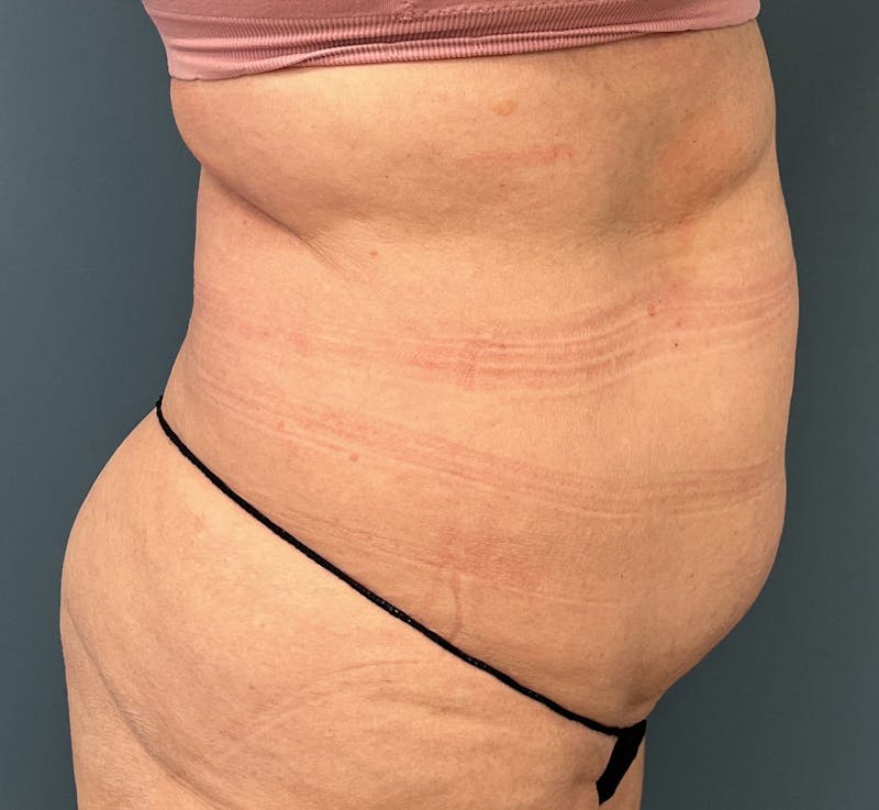 Tummy Tuck Before & After Gallery - Patient 292225 - Image 3