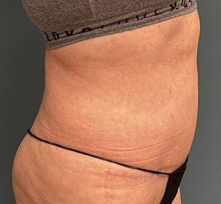 Tummy Tuck Before & After Gallery - Patient 292225 - Image 4