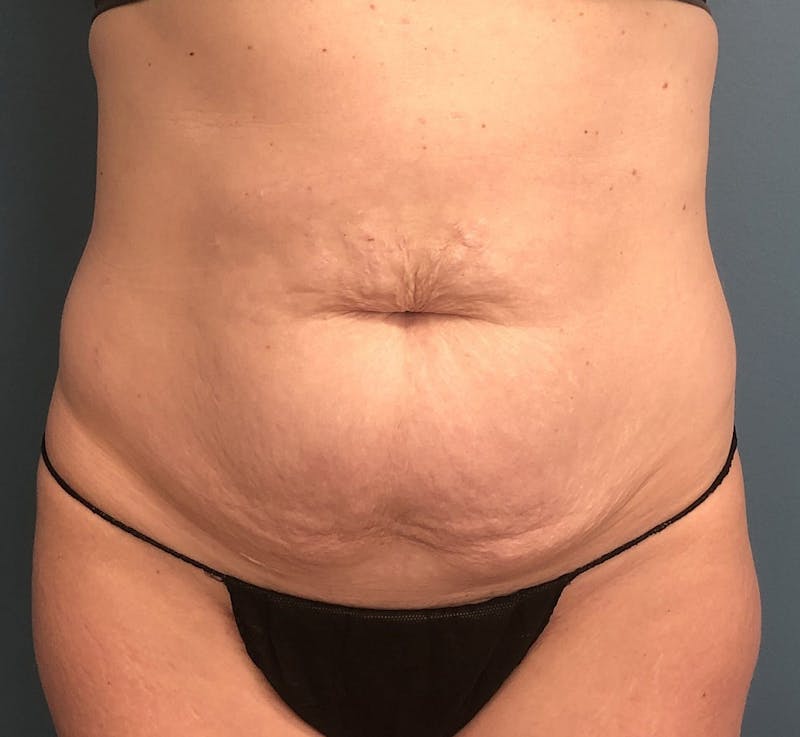 Tummy Tuck Before & After Gallery - Patient 425183 - Image 1