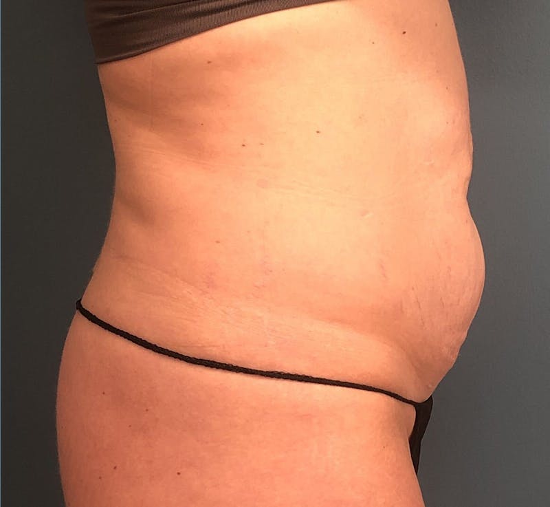 Tummy Tuck Before & After Gallery - Patient 425183 - Image 3