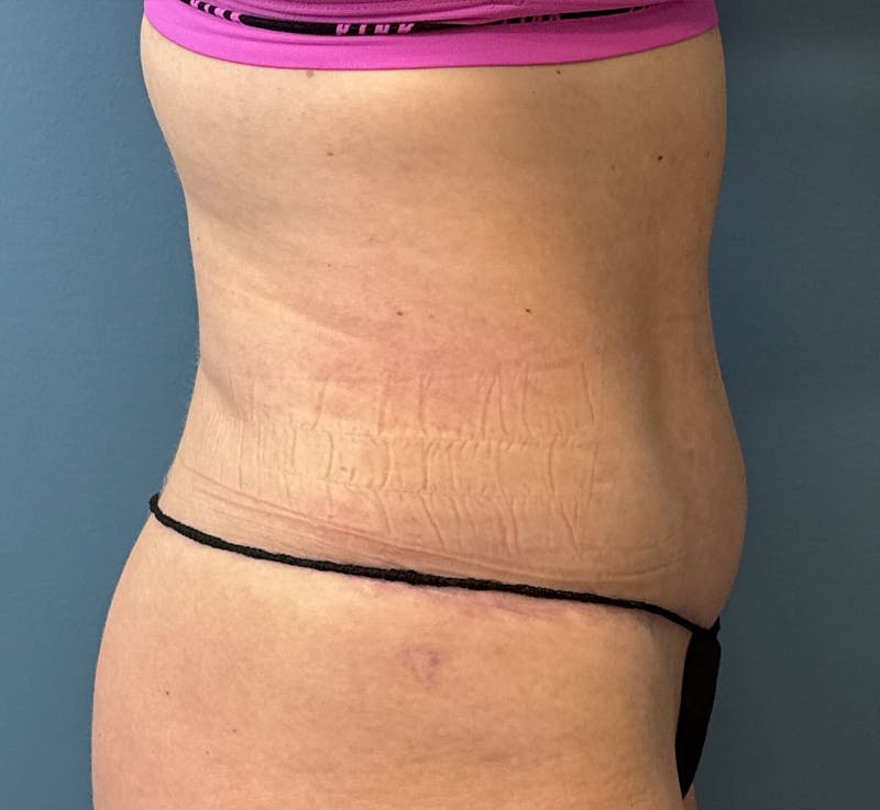 Tummy Tuck Before & After Gallery - Patient 425183 - Image 4