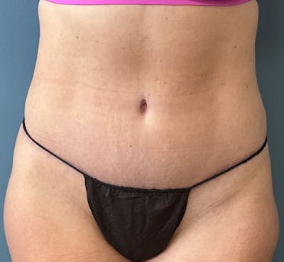 Tummy Tuck Before & After Gallery - Patient 425183 - Image 2
