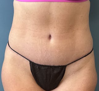 Tummy Tuck Before & After Gallery - Patient 425183 - Image 2