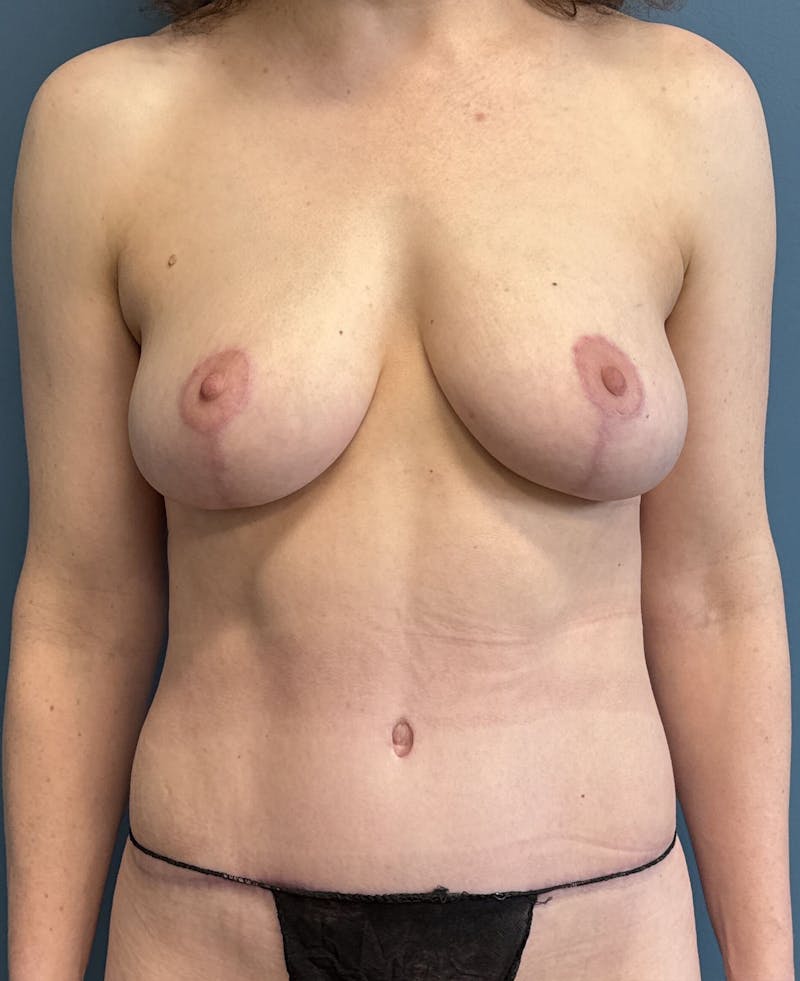 Tummy Tuck Before & After Gallery - Patient 222536 - Image 2