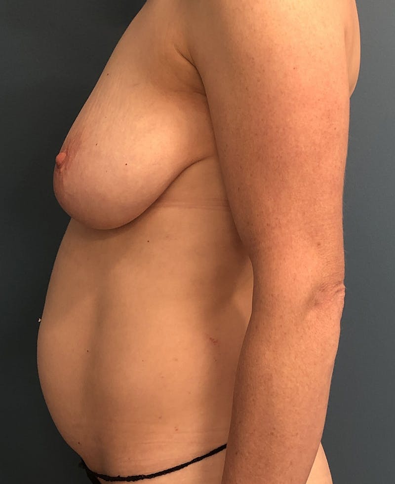 Tummy Tuck Before & After Gallery - Patient 222536 - Image 3