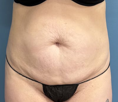 Tummy Tuck Before & After Gallery - Patient 192770 - Image 1