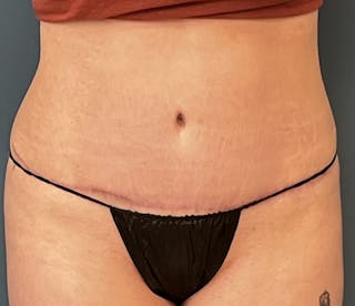 Tummy Tuck Before & After Gallery - Patient 192770 - Image 2