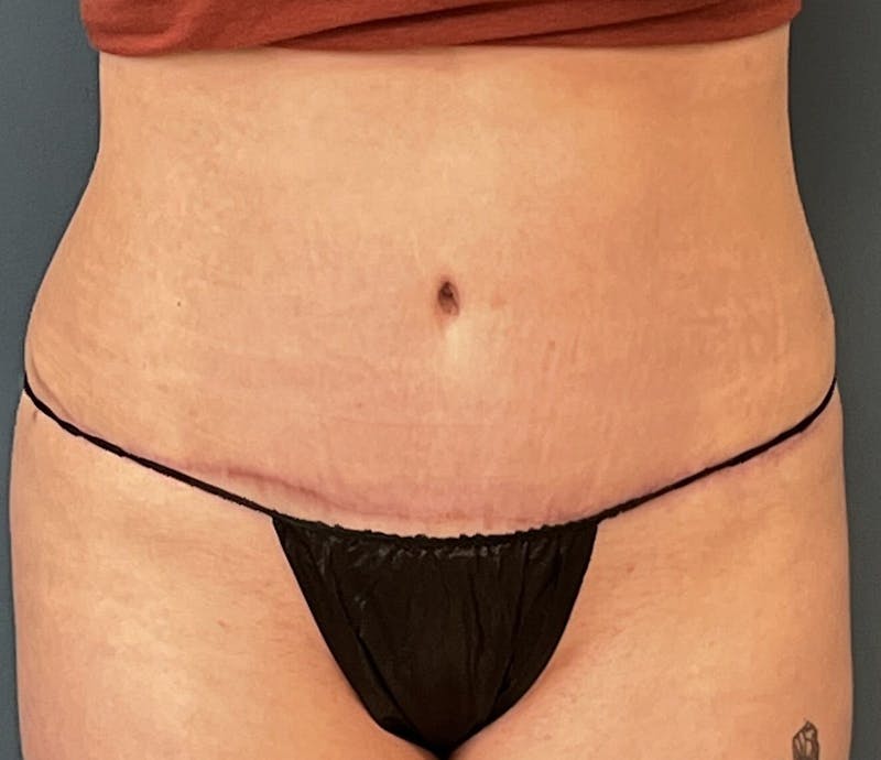 Tummy Tuck Before & After Gallery - Patient 192770 - Image 2