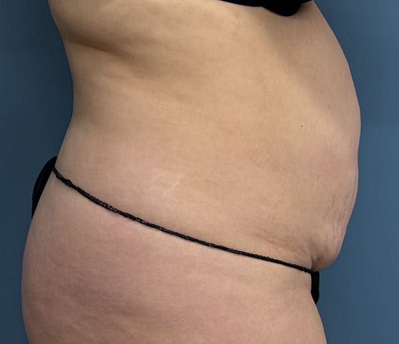 Tummy Tuck Before & After Gallery - Patient 192770 - Image 3