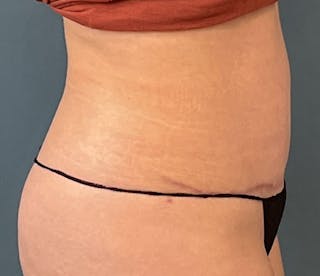 Tummy Tuck Before & After Gallery - Patient 192770 - Image 4