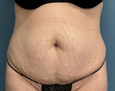 Tummy Tuck Before & After Gallery - Patient 241335 - Image 1