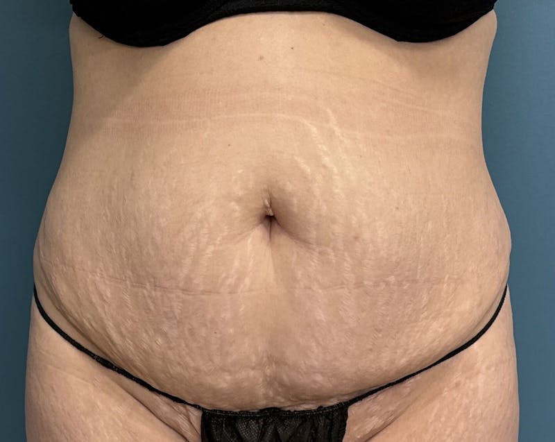 Tummy Tuck Before & After Gallery - Patient 241335 - Image 1