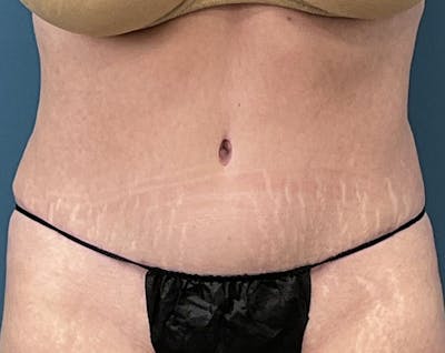 Tummy Tuck Before & After Gallery - Patient 241335 - Image 2
