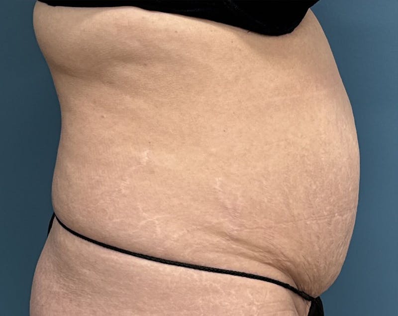 Tummy Tuck Before & After Gallery - Patient 241335 - Image 3