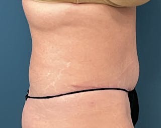 Tummy Tuck Before & After Gallery - Patient 241335 - Image 4