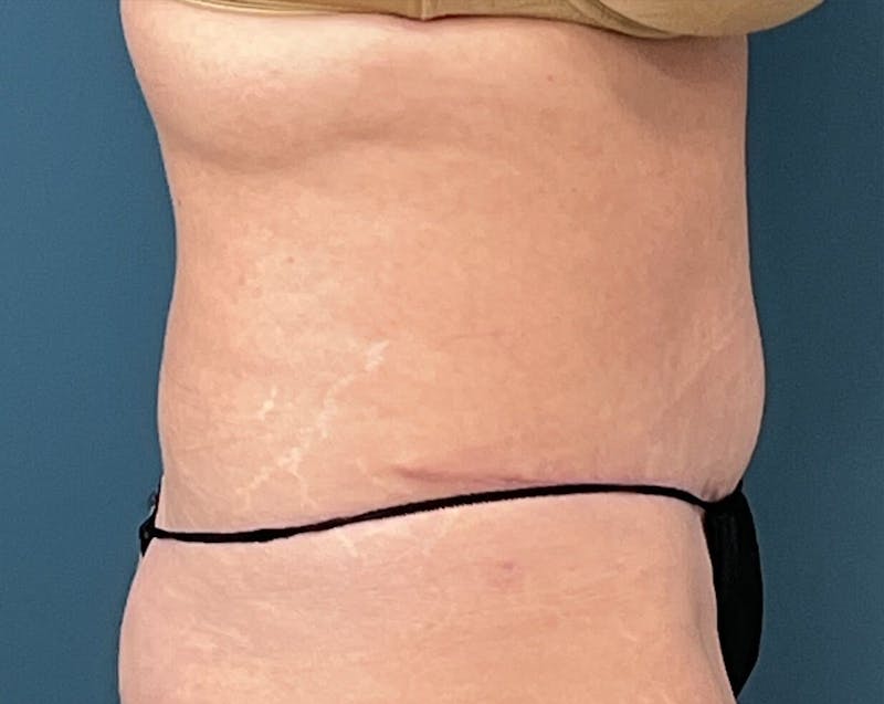 Tummy Tuck Before & After Gallery - Patient 241335 - Image 4