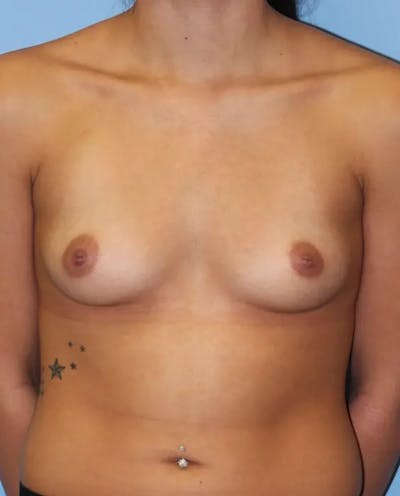 Breast Augmentation Before & After Gallery - Patient 194876 - Image 1