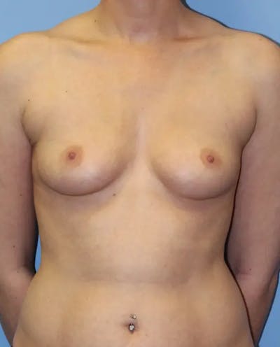 Breast Augmentation Before & After Gallery - Patient 413293 - Image 1