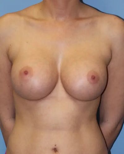 Breast Augmentation Before & After Gallery - Patient 413293 - Image 2