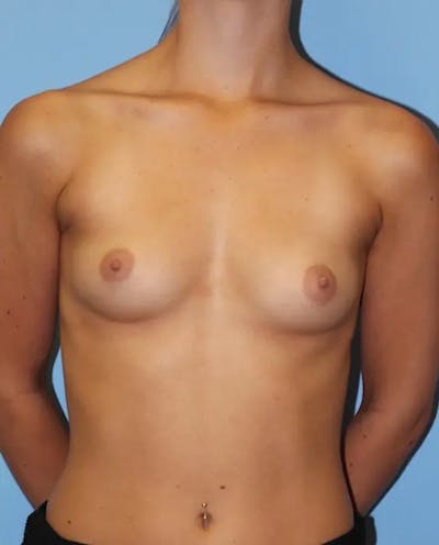 Breast Augmentation Before & After Gallery - Patient 342434 - Image 1