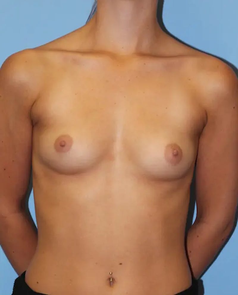 Breast Augmentation Before & After Gallery - Patient 342434 - Image 1