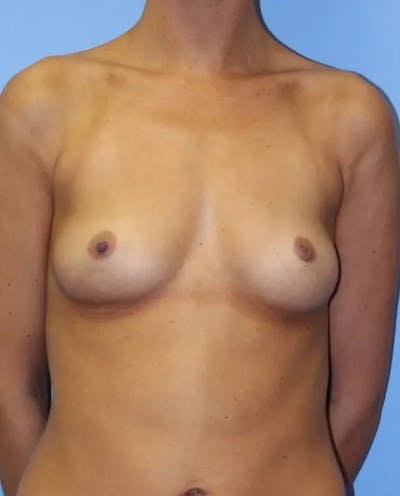 Breast Augmentation Before & After Gallery - Patient 401433 - Image 1