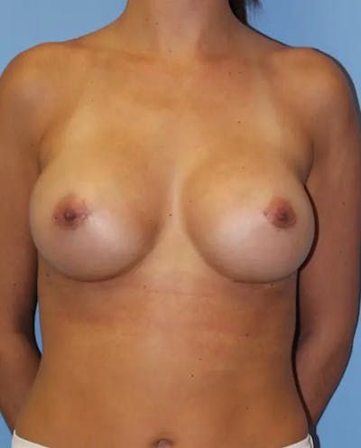 Breast Augmentation Before & After Gallery - Patient 401433 - Image 2