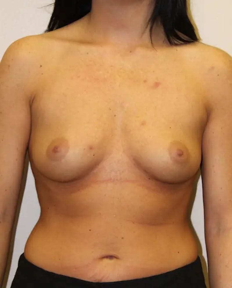 Breast Augmentation Before & After Gallery - Patient 249920 - Image 1