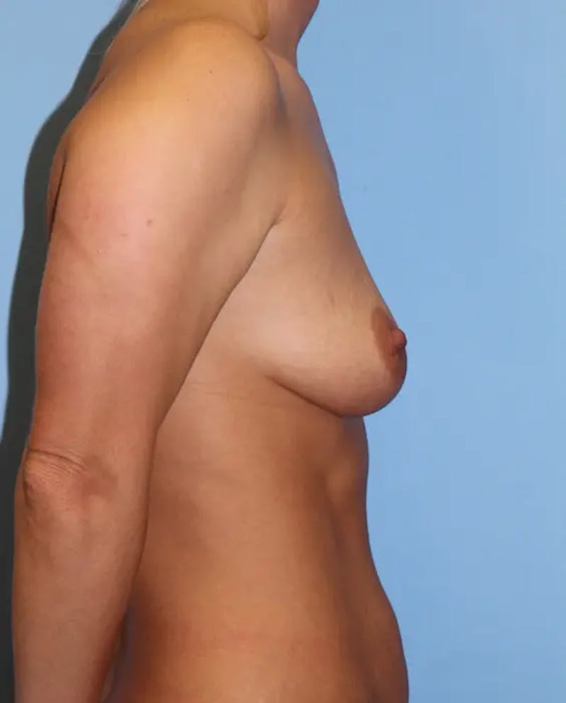 Breast Augmentation Before & After Gallery - Patient 387542 - Image 5