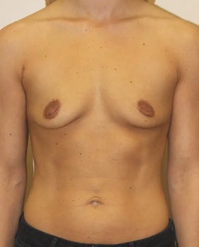Breast Augmentation Before & After Gallery - Patient 560239 - Image 1