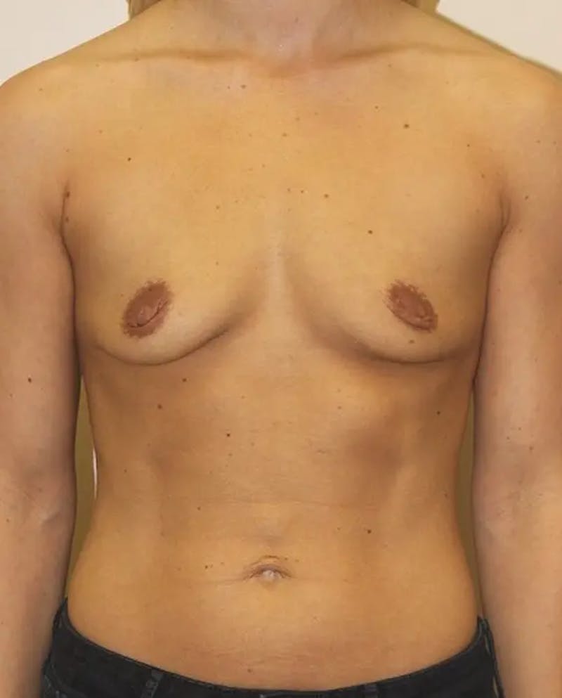 Breast Augmentation Before & After Gallery - Patient 560239 - Image 1