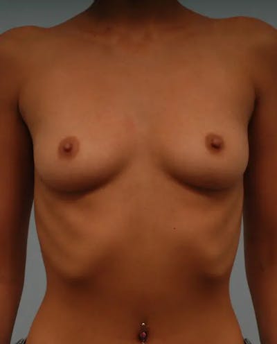 Breast Augmentation Before & After Gallery - Patient 428134 - Image 1