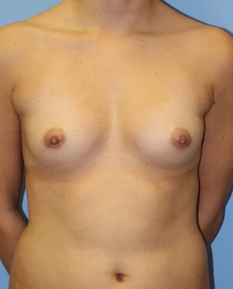 Breast Augmentation Before & After Gallery - Patient 158743 - Image 1