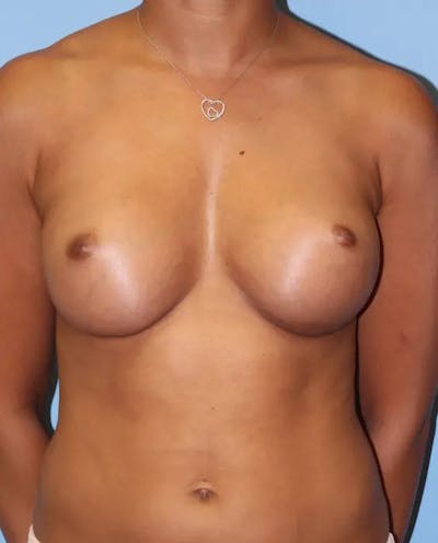 Breast Augmentation Before & After Gallery - Patient 140413 - Image 2