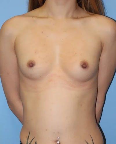 Breast Augmentation Before & After Gallery - Patient 166900 - Image 1