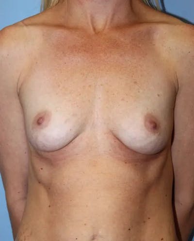 Breast Augmentation Before & After Gallery - Patient 932353 - Image 1