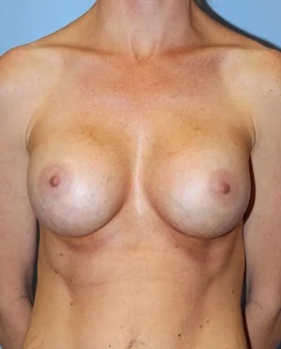 Breast Augmentation Before & After Gallery - Patient 932353 - Image 2