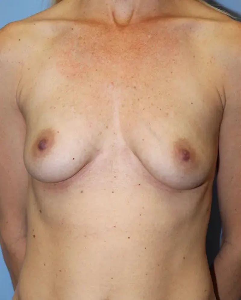 Breast Augmentation Before & After Gallery - Patient 316878 - Image 1