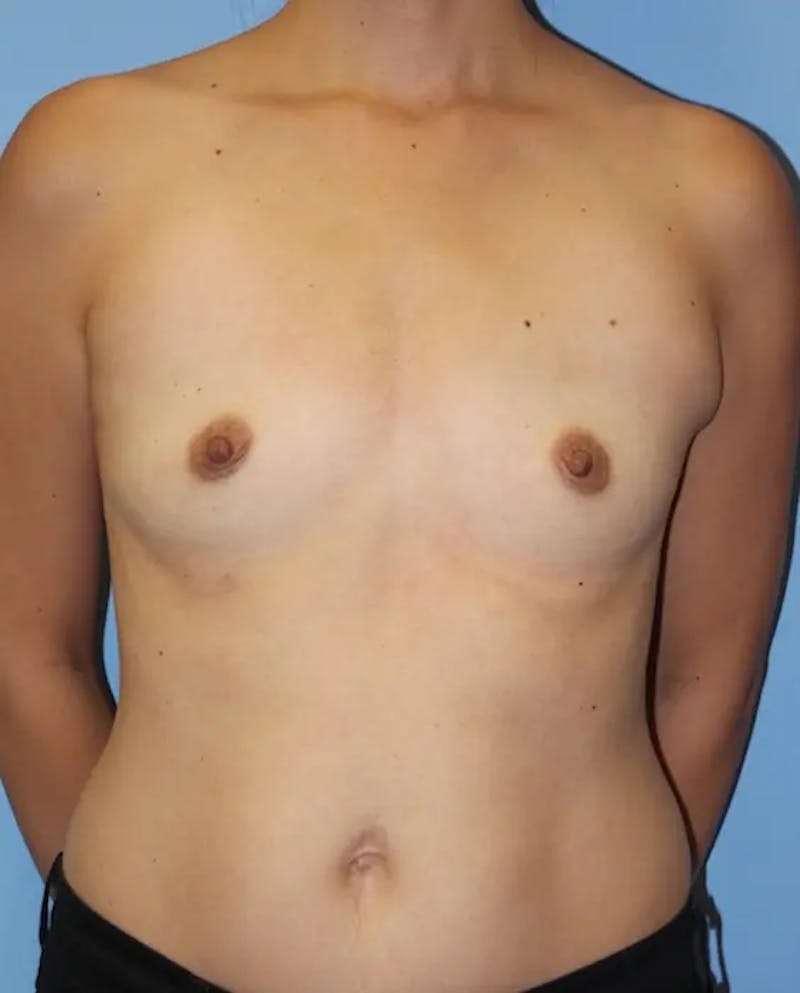 Breast Augmentation Before & After Gallery - Patient 219182 - Image 1