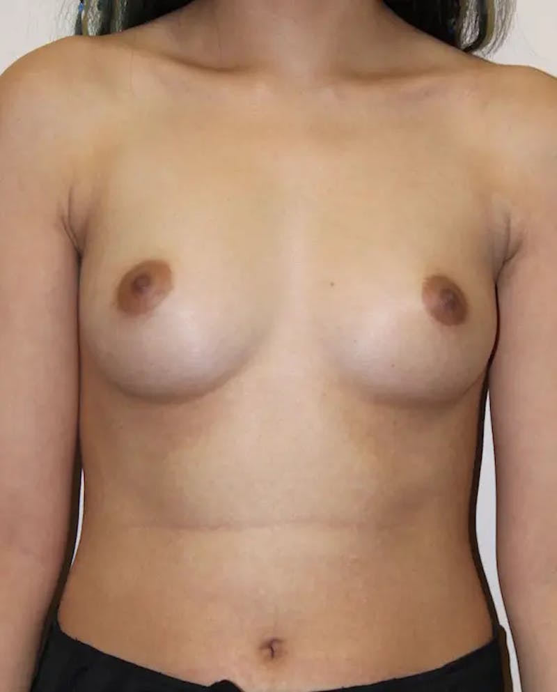 Breast Augmentation Before & After Gallery - Patient 115838 - Image 1