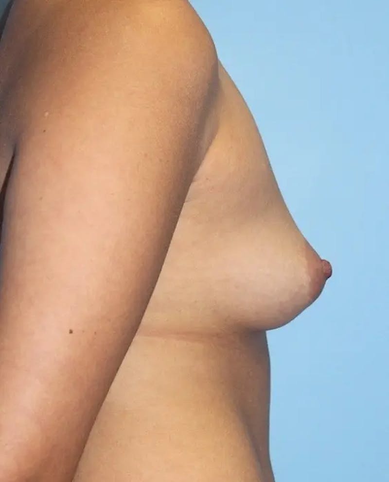 Breast Augmentation Before & After Gallery - Patient 345653 - Image 5