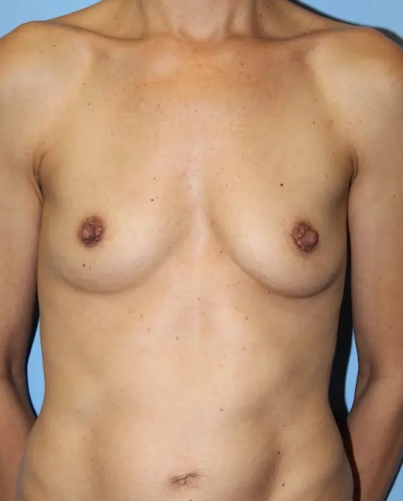Breast Augmentation Before & After Gallery - Patient 104295 - Image 1