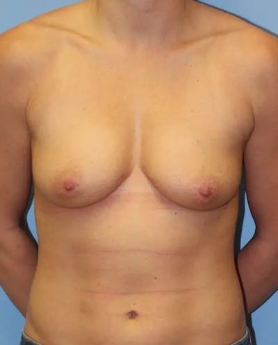 Breast Augmentation Before & After Gallery - Patient 364876 - Image 1